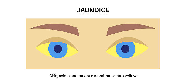 黄疸 - huáng dǎn