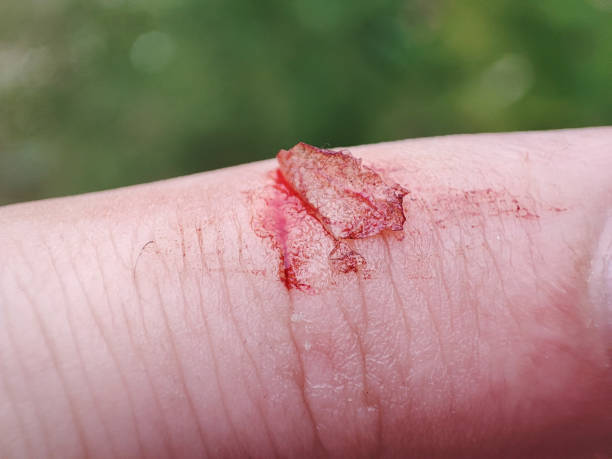 创口 - chuāng kǒu