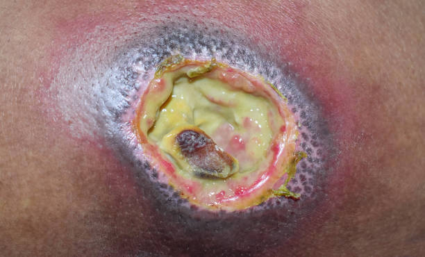 脓肿 - nóng zhǒng