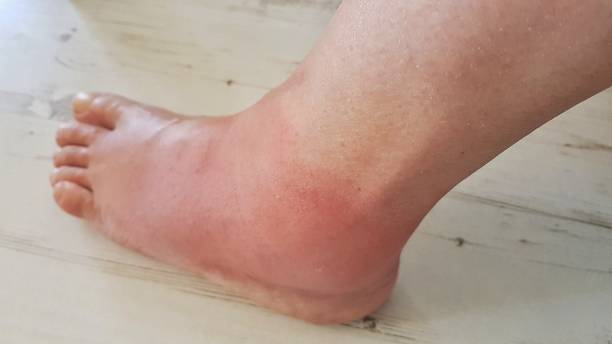 肿胀 - zhǒng zhàng