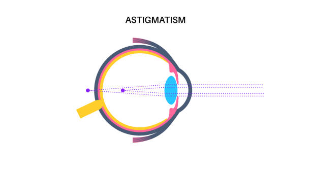 散光 - sàn guāng