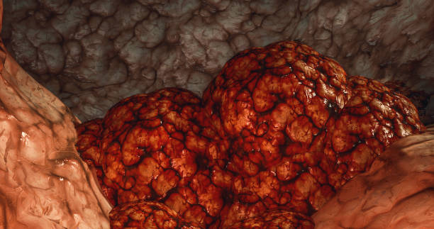 肿瘤 - zhǒng liú