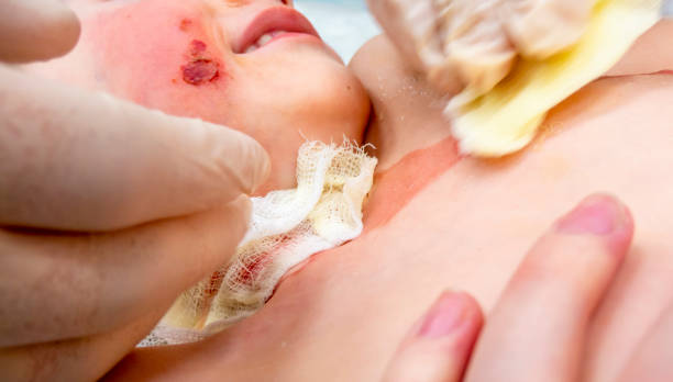 挫伤 - cuò shāng